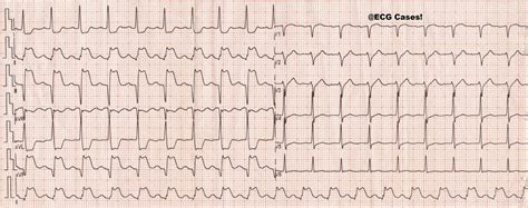 STEMI NSTEMI Culprit Artery