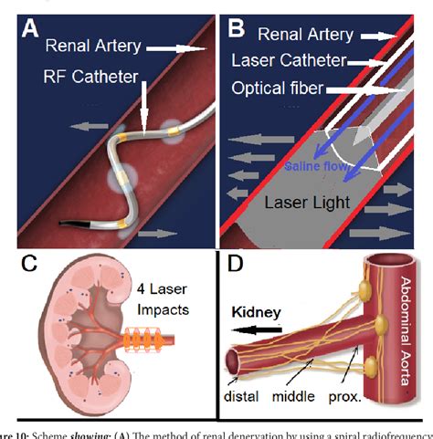 Figure 1 From Catheter Based Renal Sympathetic Denervation By Segmental