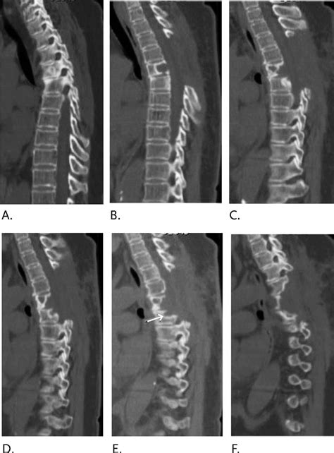 Sagittal Computed Tomography Scan From Right To Left A To F Showing Download Scientific