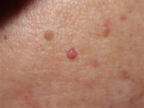 What Is The Difference Between Superficial Basal Cell Carcinoma And