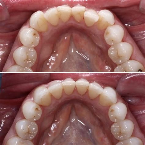 Before And Afters Schaumburg Dentistry