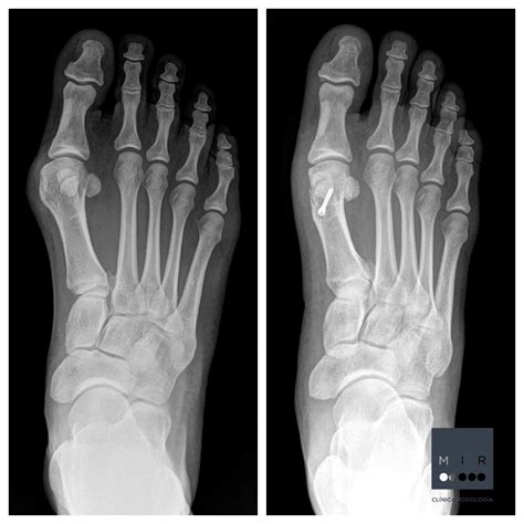 Radiograf A Pre Y Postquir Rgica De Una Cirug A De Hallux Valgus