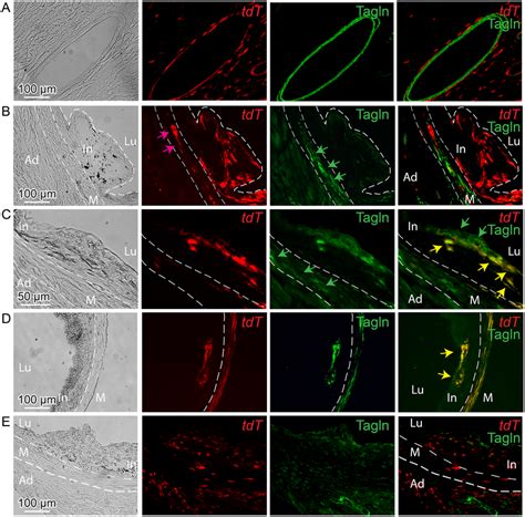 Tcf21 Expressing Cells In ApoE Lesions Give Rise To Smooth Muscle