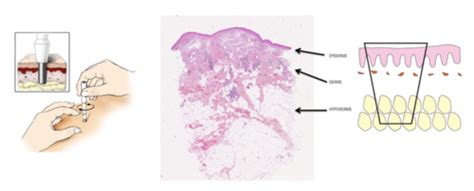 C3 Biopsie cutanée et éléments d anapath cutanée Flashcards Quizlet