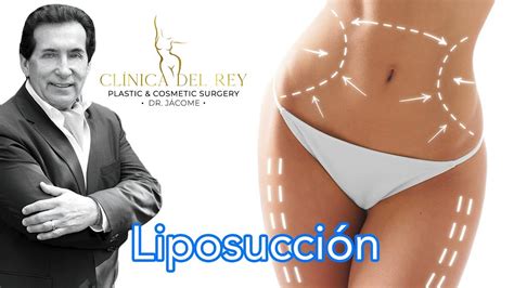 Liposucci N En Cl Nica Del Rey Dr Franco Reyes J Come Youtube