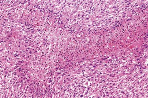 The Histology Of Leiomyosarcoma It Shows Composed Of Spindle Cells