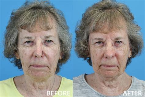 Before And After Facial Plastic Surgery Center Washington