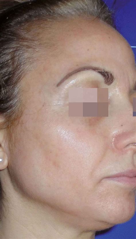 Cosmelan Peel Costs And Faqs To Treat Pigmentation And Melasma