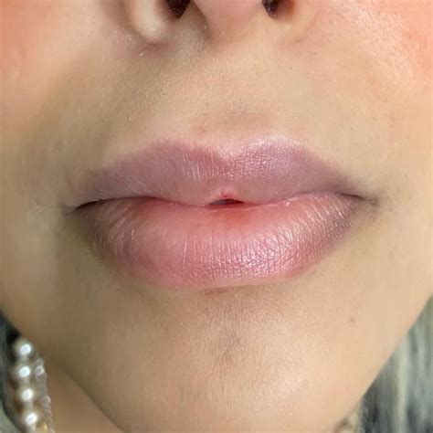 Lip Filler Dissolving Treatment Using Hyalase Hyaluronidase In London