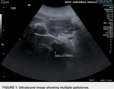 Figure From Cholecystoduodenal Fistula Evading Imaging And Endoscopic