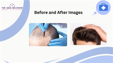 Ppt Hair Transplant Surgery Bhubaneswar Powerpoint Presentation Free Download Id 13088721