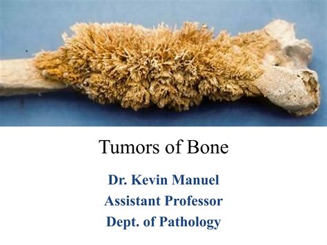 Tumors of bone | PPTX