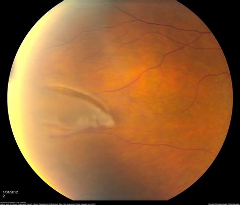 Retinal Tear Hole Annan Retina Eye Center In Houston Texas