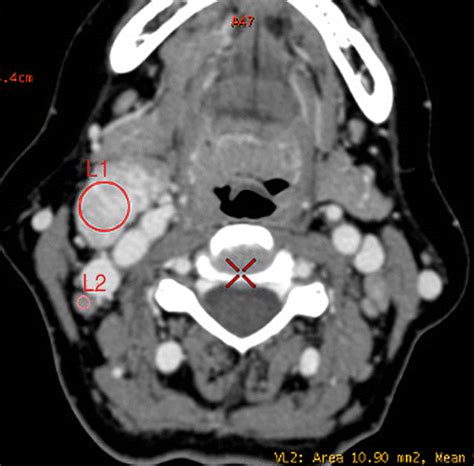 Papillary Thyroid Cancer Dual Energy Spectral CT Quantitative