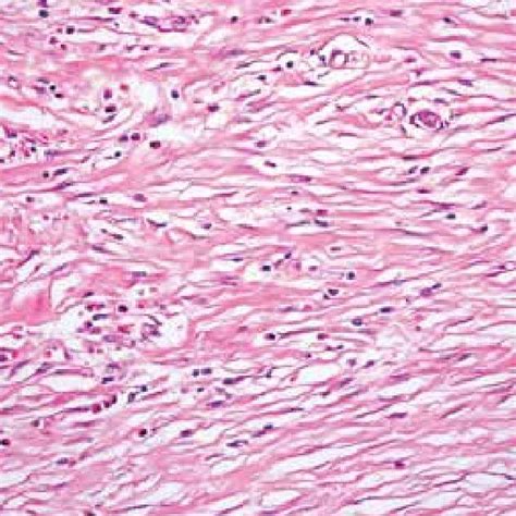 Fibrous Tissue Bundles Of Spindle Cells Between Mononuclear