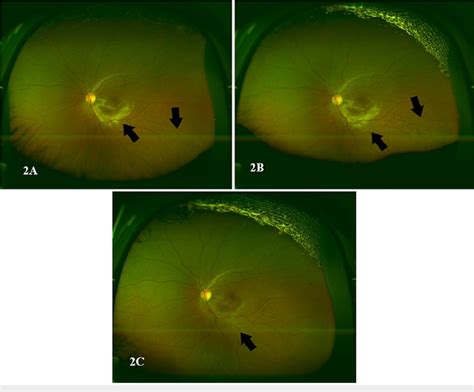 Optos Color Fundus Photo Of The Left Eye A Optos Color Fundus Photo Download Scientific