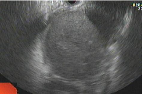 Infected Walled Off Pancreatic Necrosis Following Eus Guided Drainage Successfully Treated Using