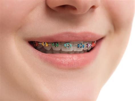 Self Ligating Ceramic Conventional And Other Types Of Braces