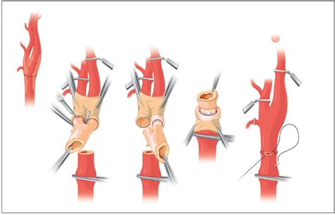 Carotid Endarterectomy A Técnica de Eversão Cholloventas