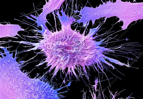 Cervical Cancer Cells Sem Stock Image C Science Photo