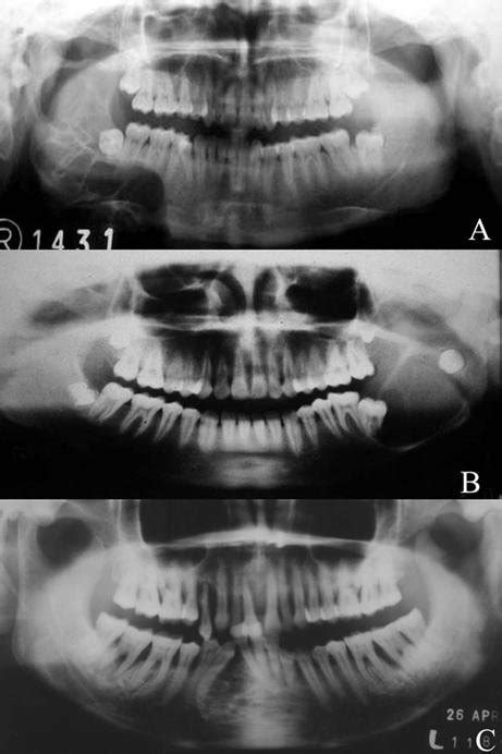 A Ameloblastoma Presenting As A Multilocular Radiolucency Involving