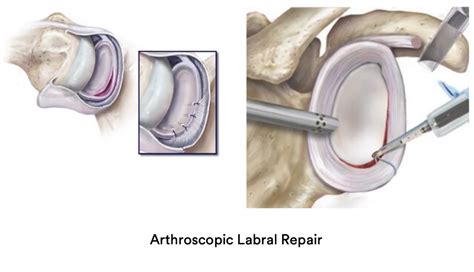 Arthroscopic Labral Repair Shoulder Surgery Sydney Shoulder Unit