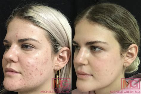 Clarisonic Before And After Acne Scars