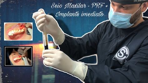 Levantamento Seio Maxilar Prf Implante Imediato Dr Jo O