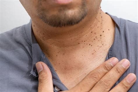 Why You Should Never Remove Skin Tags Yourself Jordan Valley