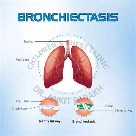 Bronchiectasis Causes Symptoms And Diagnosis Dr Ankit Parakh