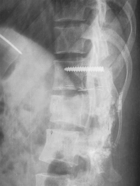 The Role Of Fusion In The Management Of Burst Fractures Of The