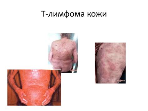 Лимфомы. Лимфогранулематоз - презентация онлайн