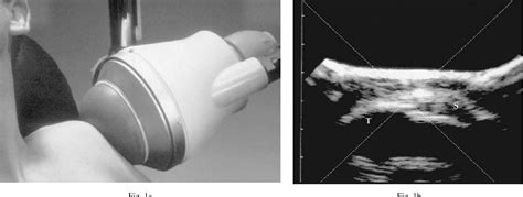 Figure 2 From Low Energy Extracorporeal Shock Wave Treatment Eswt For