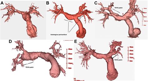 Multiple Pulmonary Artery Plasty With Tissue Engineered Vascular Grafts