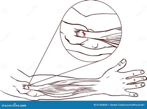 Elbow Common Extensor Tendon Tear