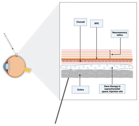 Jcm Free Full Text Subretinal Injection Techniques For Retinal