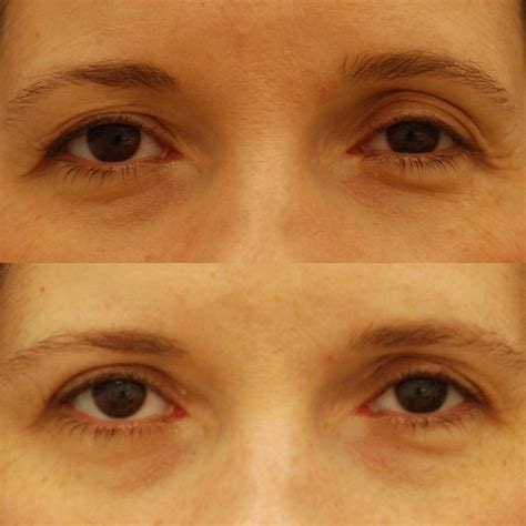 Blepharoplasty Scars