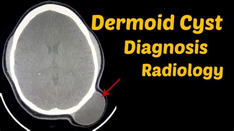 Dermoid Cyst Skull Diagnosis Ct Scan Radiology Youtube