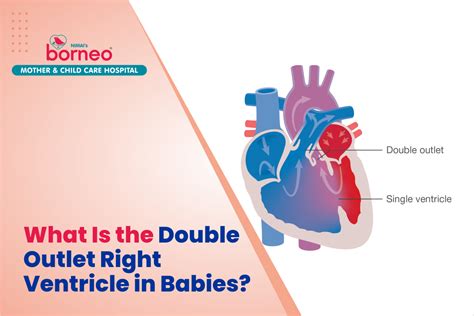 Exploring Double Outlet Right Ventricle In Babies Borneo Main