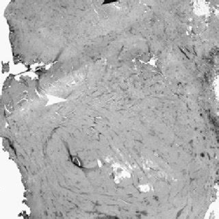 Pdf Rules For Anal Fistulas With Scrotal Extension