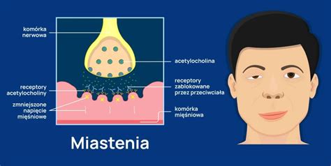 Miastenia Przyczyny Objawy Diagnostyka Leczenie