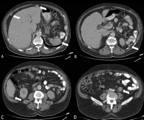 Splenosis Normal Spleen Is Absent There Are Multiple Round Enhancing