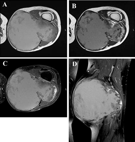 PDF A Rare Manifestation Of Extraskeletal Myxoid Chondrosarcoma With