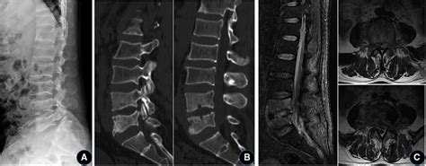 Frontiers Treatment Of Lumbar Brucella Spondylitis With Negative