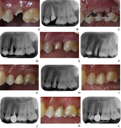 Surgical Extrusion A Dental Technique Journal Of Prosthetic Dentistry