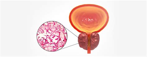 Enlarged Prostate Surgery - Doctive | Enlarged Prostate Treatment