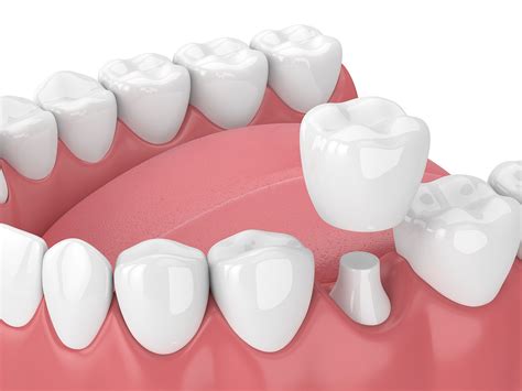 Dental Crowns Brisbane — Queensland Prosthodontics Dr Michael Brandon