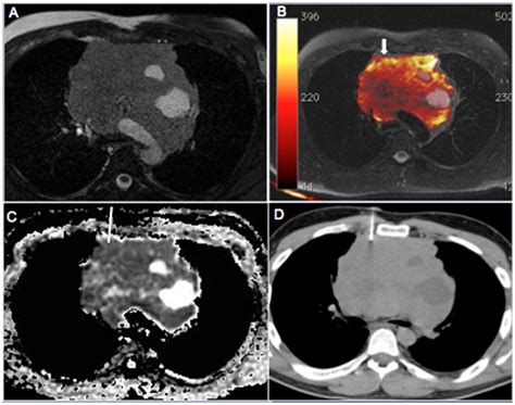 Scielo Brasil Improving Ct Guided Transthoracic Biopsy Of