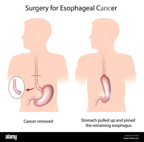 Surgery For Treatment Of Esophageal Cancer Stock Photo Alamy