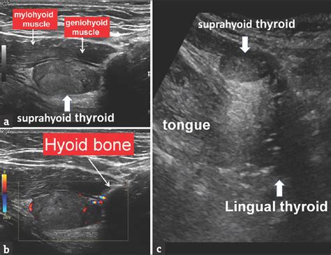 Ectopic Thyroid